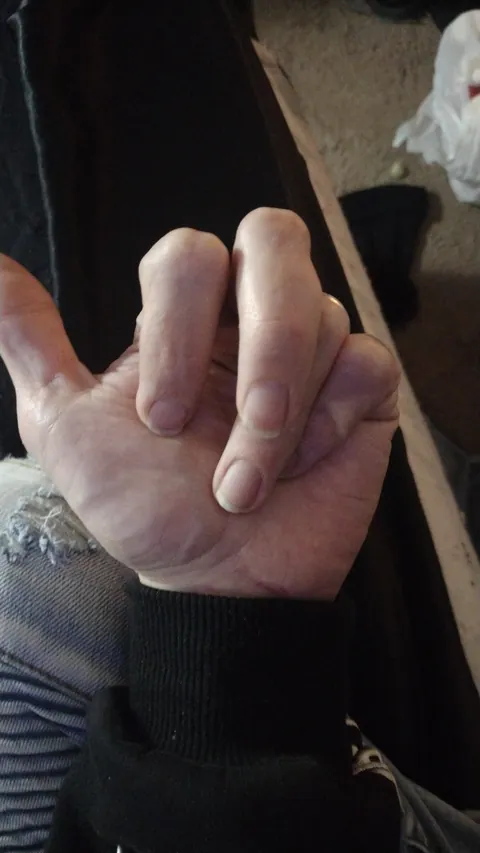 Orthopedic surgeon reattached my finger bone rotated a few degrees so I can't close it or grip