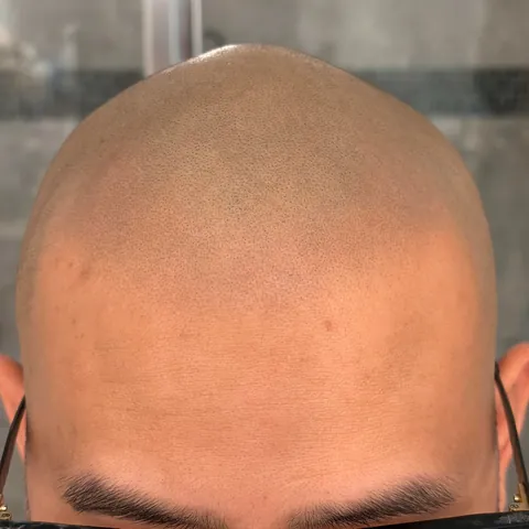 SMP Hairline Tattoo (1 Year Healed) - Current vs Before Tattoo - Alex Corona/Panama City Beach, FL