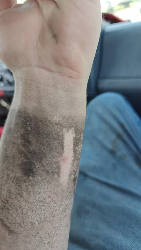 An old scar on my arm doesn't get dirty at work