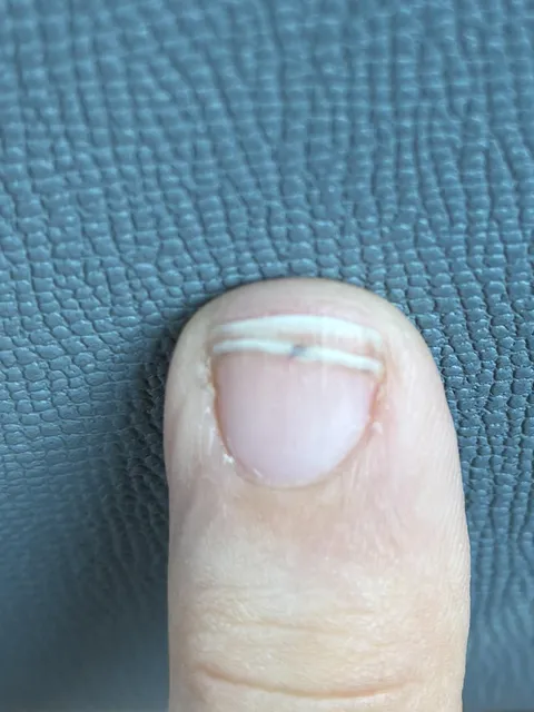 My finger is growing a double nail after I accidentally stabbed it with a needle