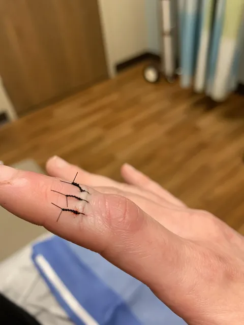 The length of the knots that got put on my stitches