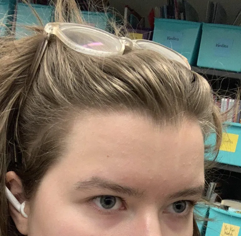 i have two very faint white lines on the middle of my forehead