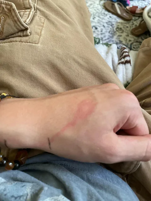 A mosquito bit my hand, and this line has appeared