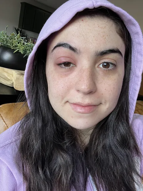 Got a stye the day before my bf’s bday trip. On day 3