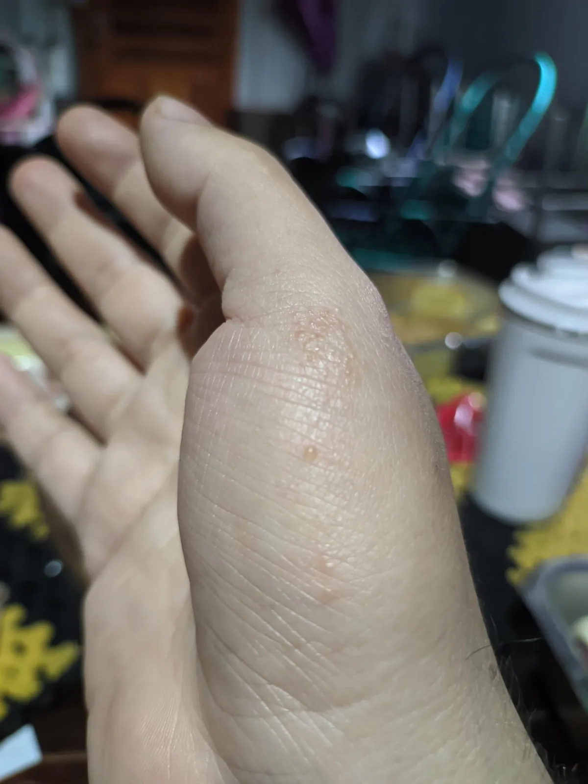 My dermatitis has evolved in just four days, and it only appears when I'm particularly stressed, always in the same spot. It's so itchy, it's a nightmare to work with.