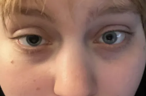 Woke up from a nap and my pupils are two different sizes