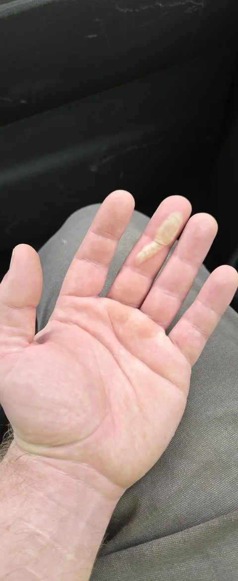 Burned my finger and now I won't be able to play guitar for a while :(