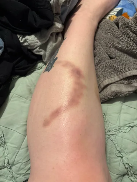 I think I was bit by a shark in my dream