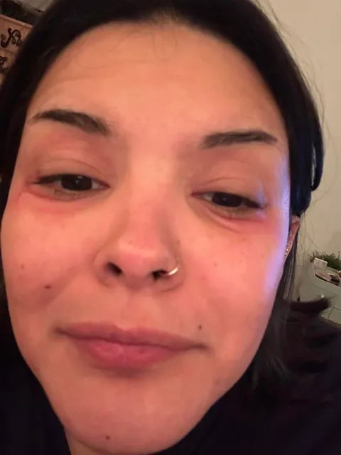 Watch my eyes blow up from the arnica in my concealer