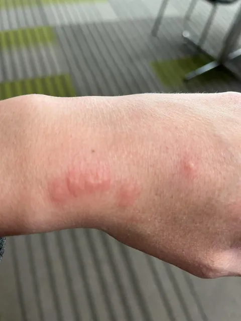 These bumps randomly showed up on my hand and I can’t figure out what caused it…