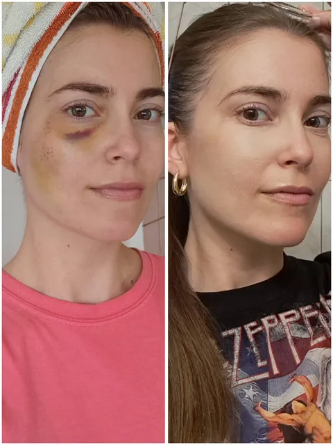 First time trying color correction for bruise coverup