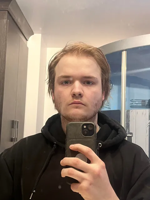 I am balding since I’m 14y/o