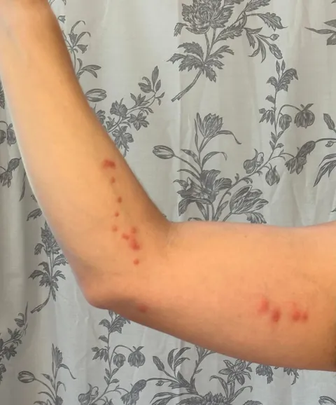 Went on vacation, hotel had bed bugs.