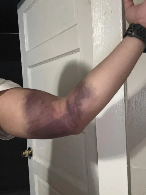 Donated blood 6 days ago and I kept all the blood