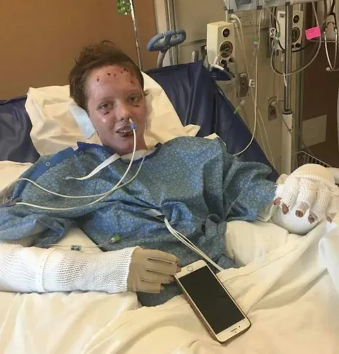 Almost 6 years post burn!!