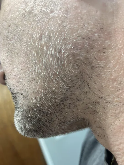 The Swirl. My facial hair grows in a circular pattern at the back of my jawline.