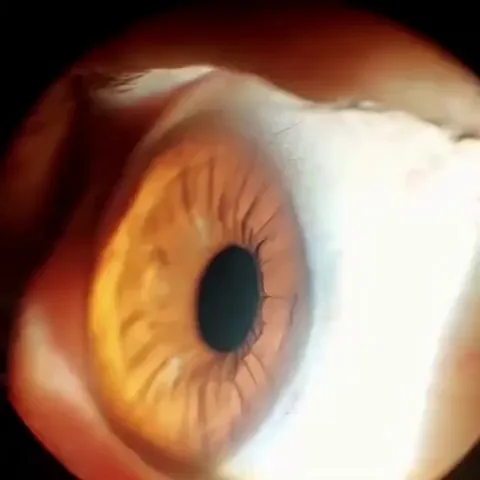 Iridodonesis. A condition in which the iris vibrates during eye movement