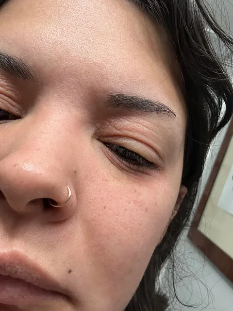 Watch my eyes blow up from the arnica in my concealer