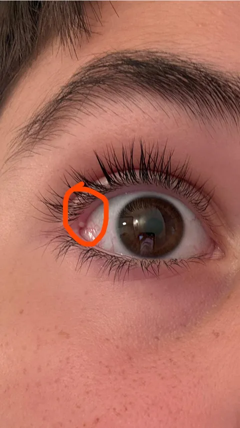 There is a pimple in my eyelid that hurts like hell
