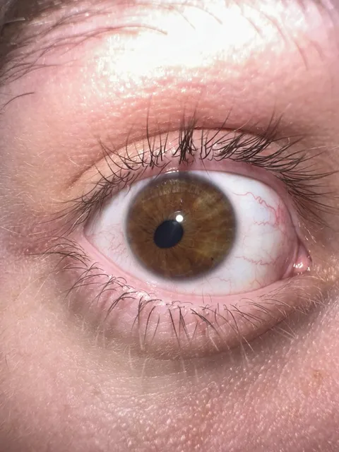 My right pupil isn’t centered nor is it a circle
