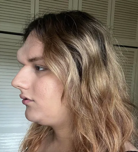 How do i get rid of the greyish tone around my mouth and forehead?