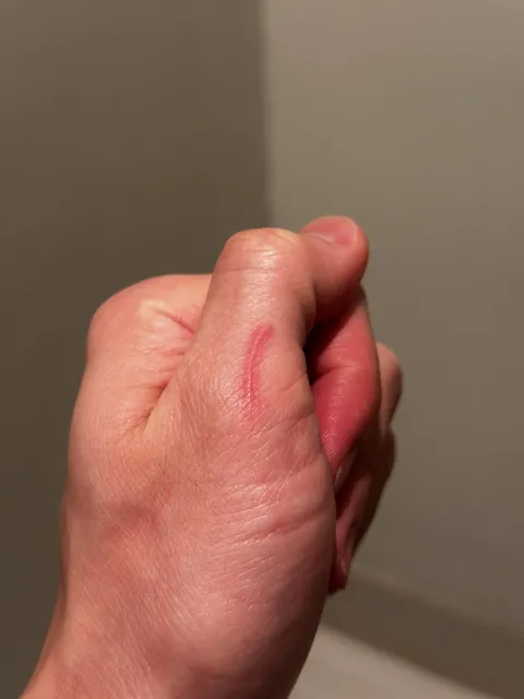 When I drink alcohol my scar on my thumb lights up like a neon light or lightsaber 