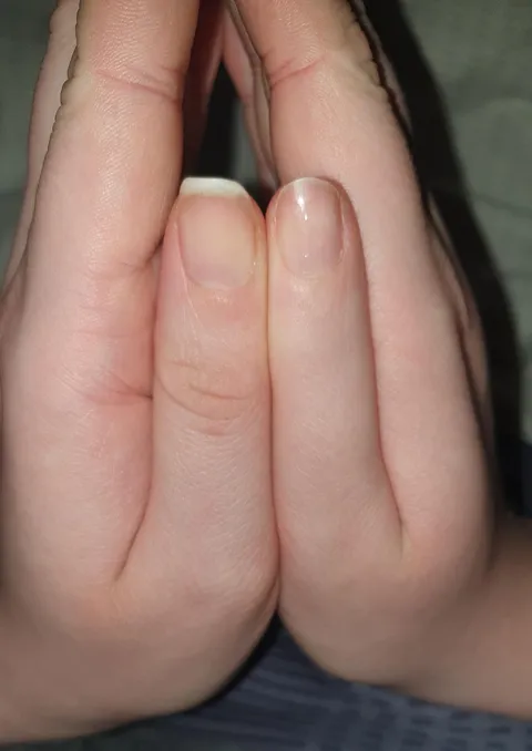 The right joint of my thumb never developed. I can't bend it.