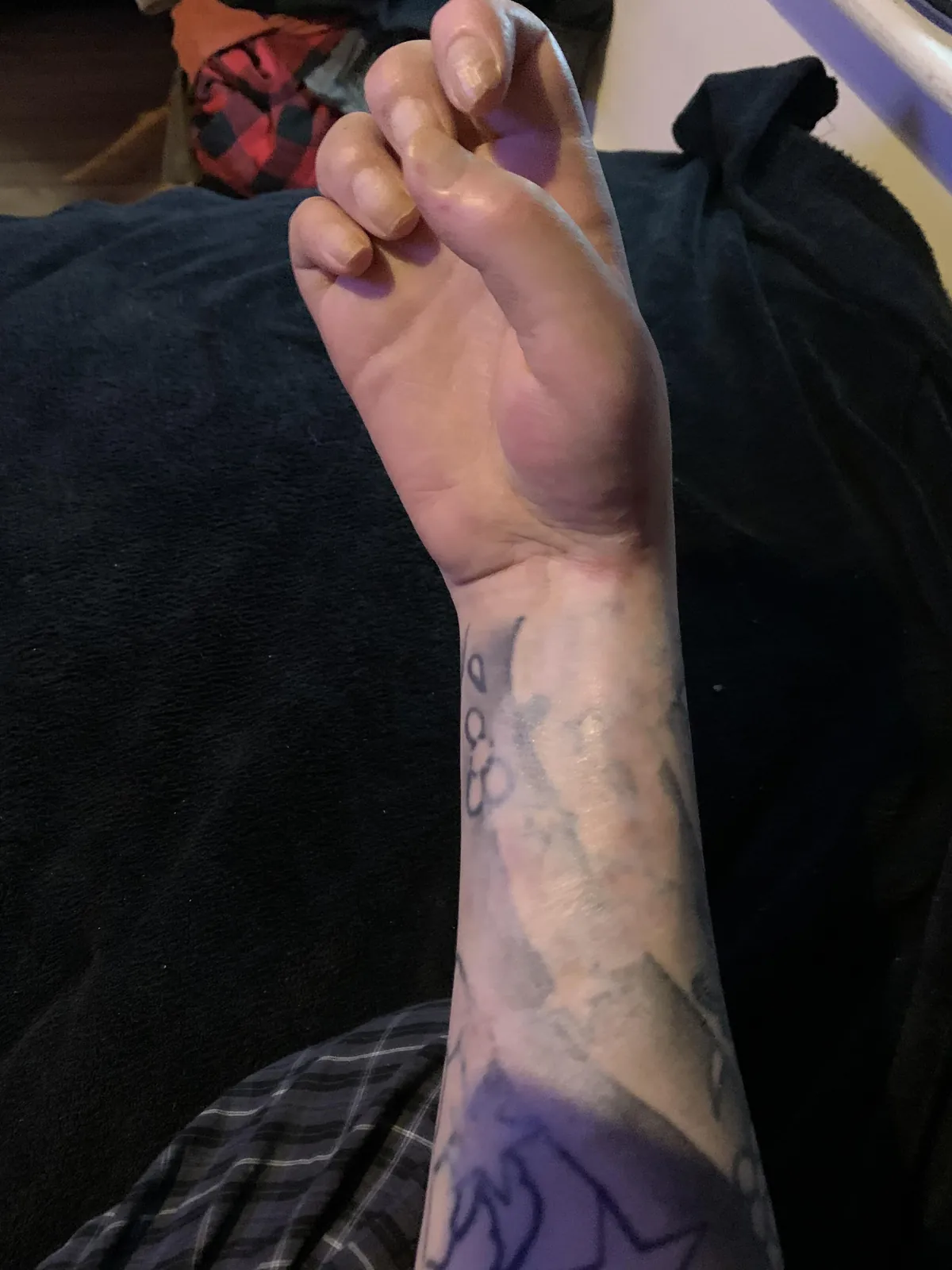 I was electrocuted, here’s my dominant hand, one year later.