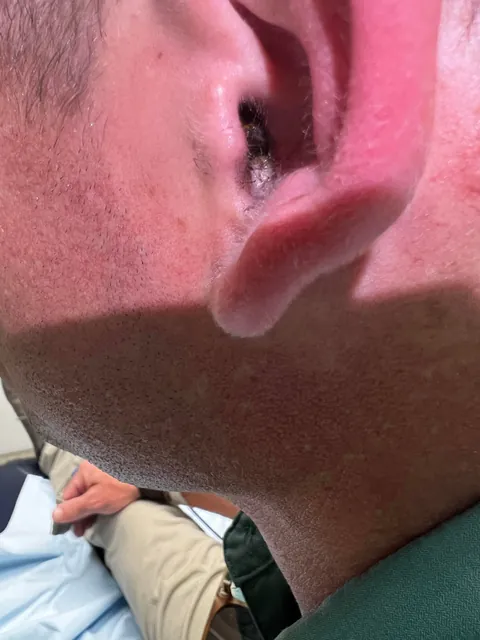 A moth flew into my ear and had to go to the ER