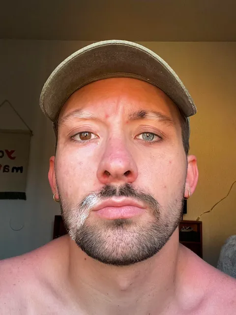 I have Vitiligo &amp; Heterochromia