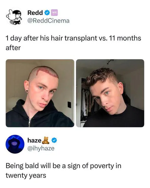 Being bald will be a sign of poverty in twenty years