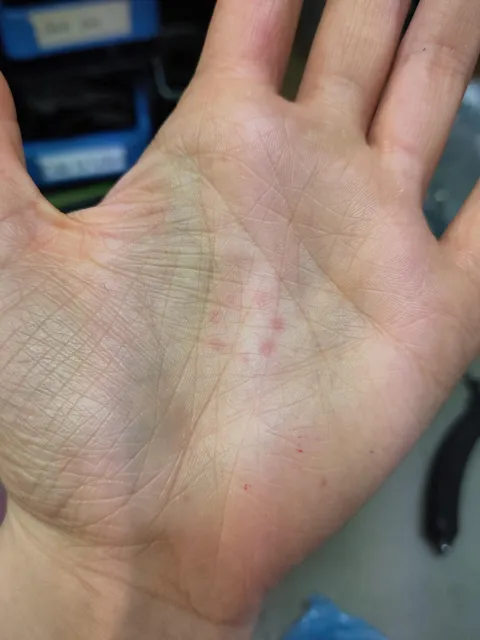 Have had a near perfect ring of red dots of my palm for 2 days