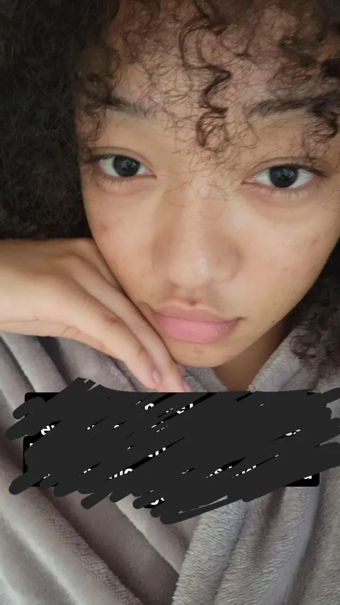 Ive been wearing fake freckles for a year instead of foundation as a way to hide acne scarring and improve my skin