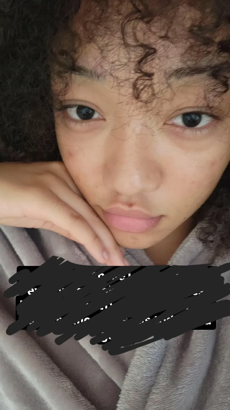 Ive been wearing fake freckles for a year instead of foundation as a way to hide acne scarring and improve my skin