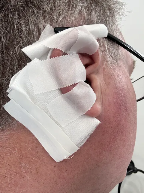 For the past 6 years, my previous dermatologist told me the spot behind my ear was “nothing to worry about”.