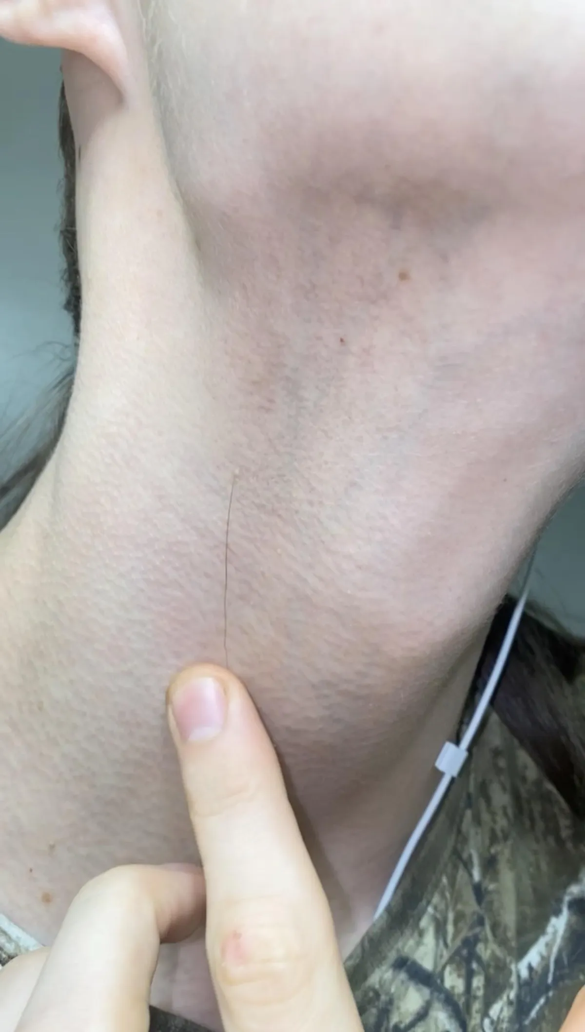 Cant grow facial hair besides this one long hair.