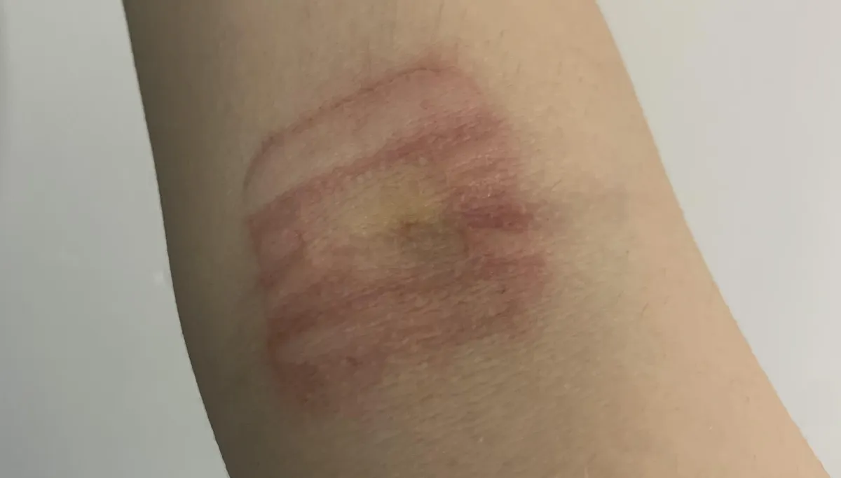 is it normal for bandaids to do this? (it was on for about 15 hours)