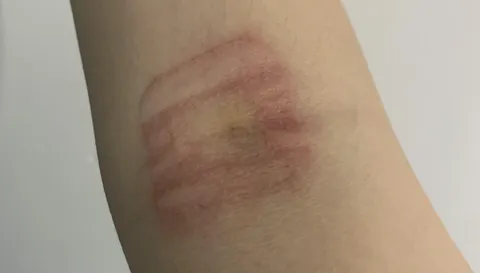 is it normal for bandaids to do this? (it was on for about 15 hours)