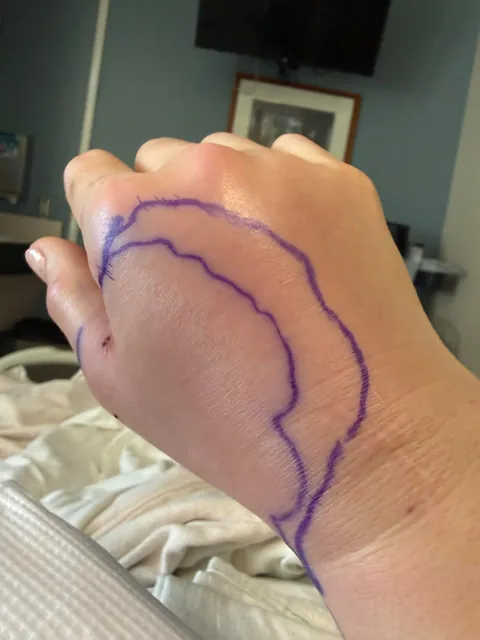 Just a reminder how serious cat bites can be!