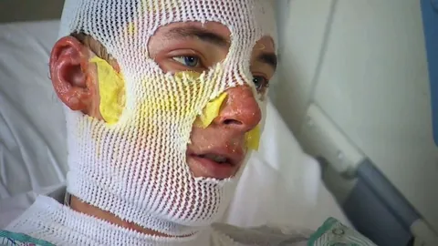 Derrick Byrd, 20, sustained second- and third-degree burns on his face, arms, and back after rushing back into a burning home to save his 8-year-old niece.