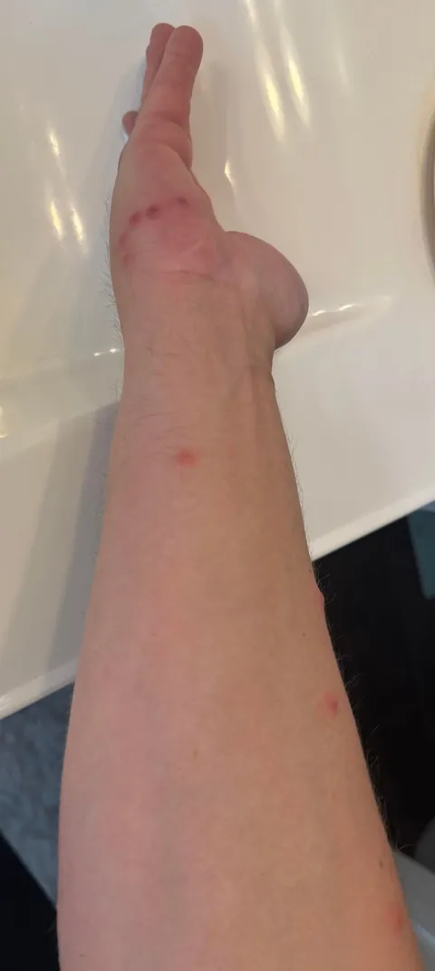 Went on vacation, hotel had bed bugs.