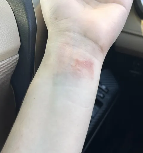 My old Apple watch band gave me a rash so i bought a new one and it gave me a rash too lol