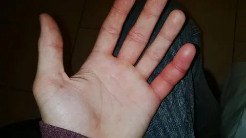 My little finger after an small insect bite