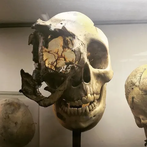 Mütter Museum Damaged Skull