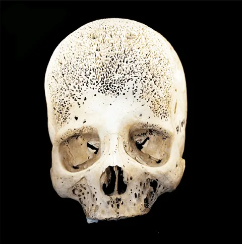 Skull in beta-thalassemia.