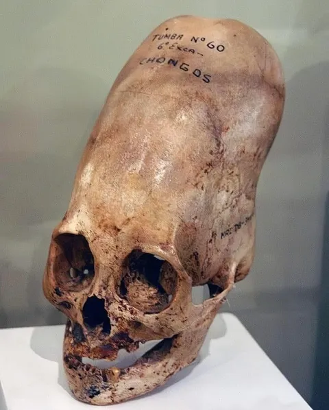 Would someone with this intentionally shaped skull experience headaches and/or other negative effects?