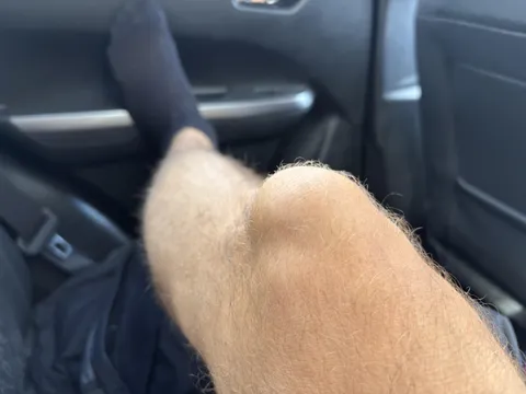 My knee spontaneously doubled in size