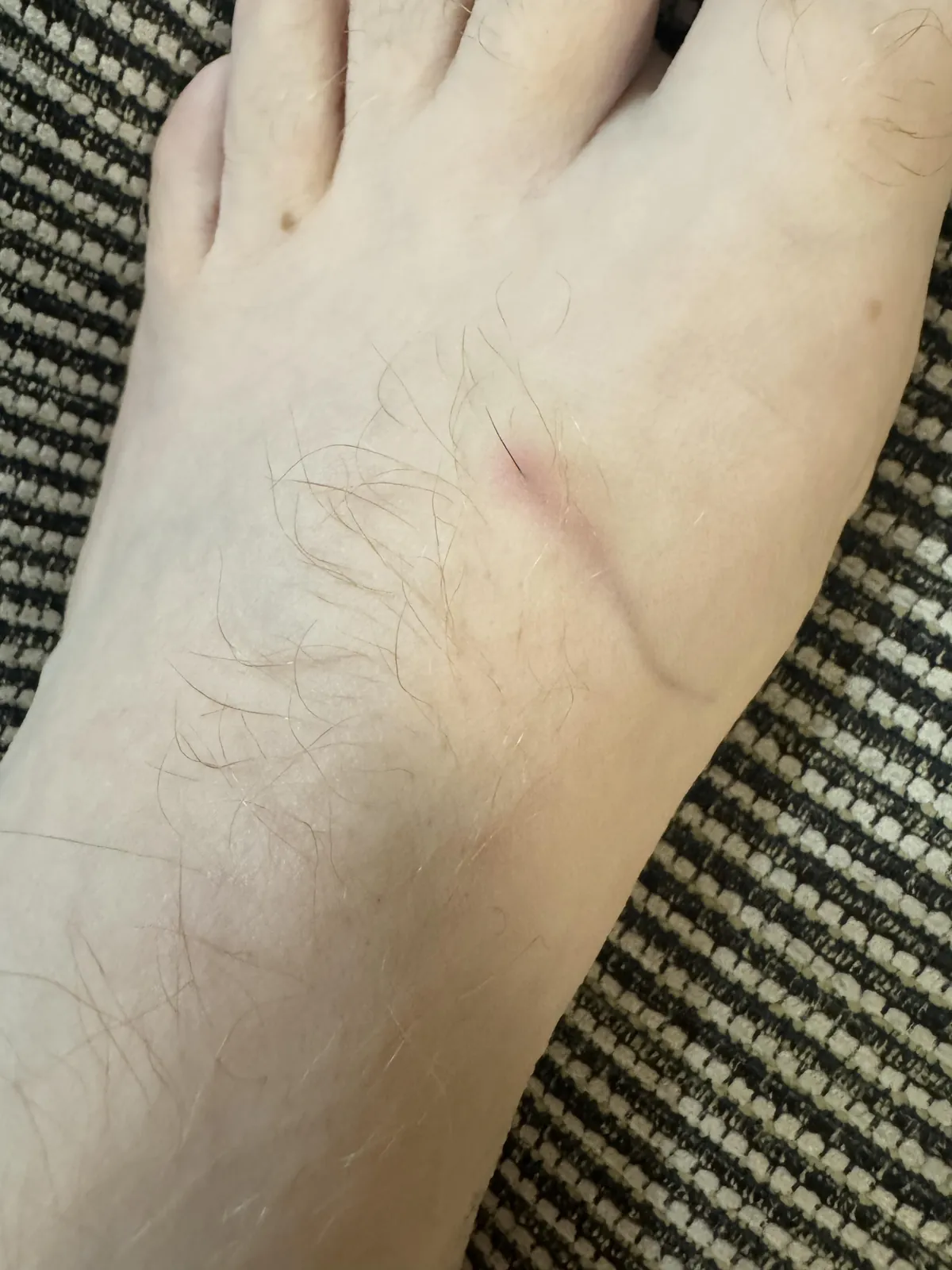 This dog hair “splinter” that appeared this morning.