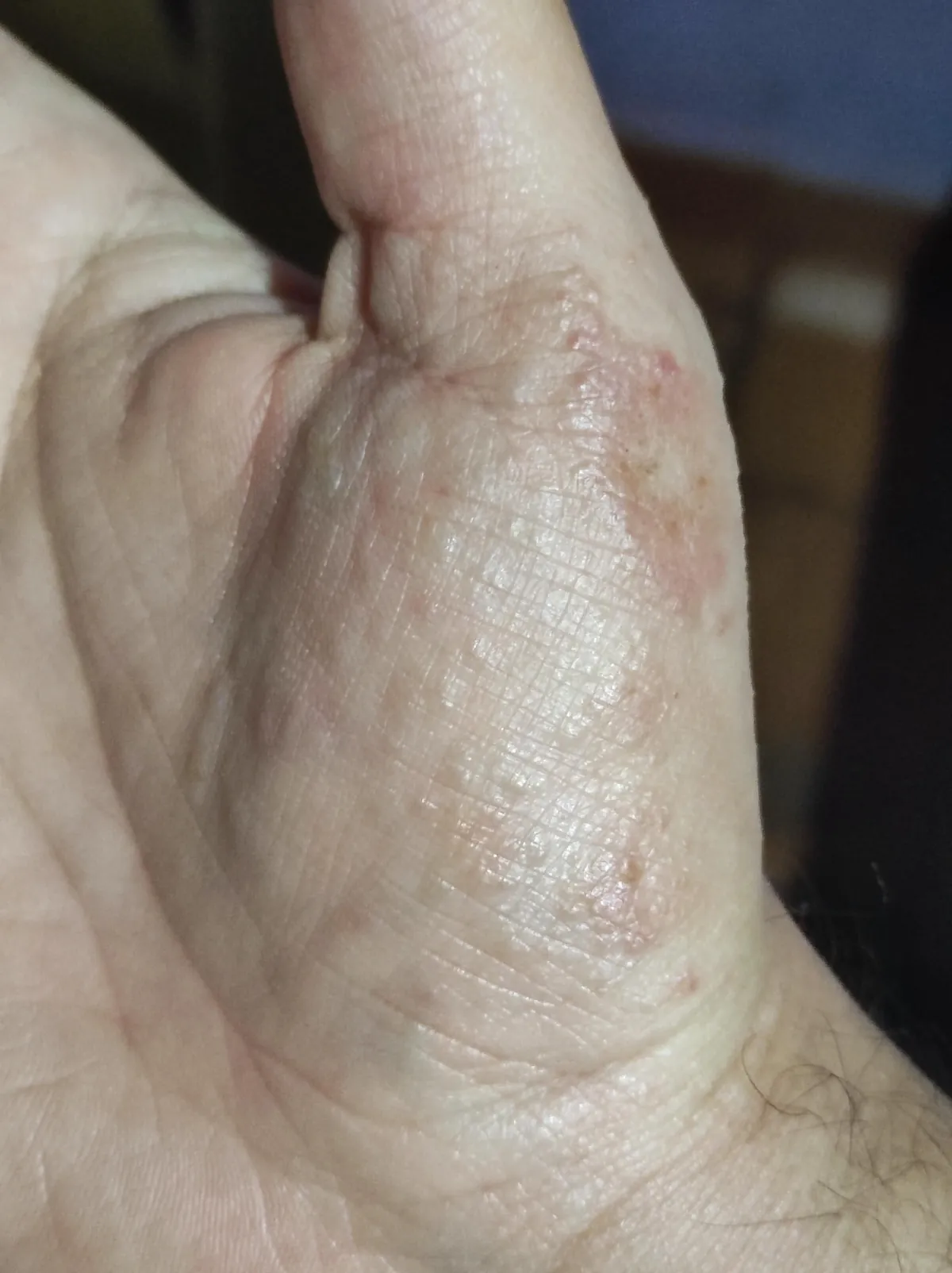 My dermatitis has evolved in just four days, and it only appears when I'm particularly stressed, always in the same spot. It's so itchy, it's a nightmare to work with.
