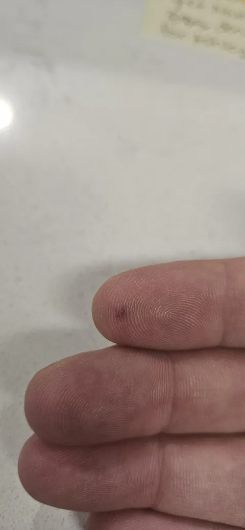 I tested my blood sugar 4 years ago and I still have a scar.